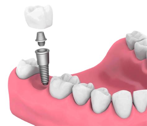 dental implants penge|Dentist Penge [ Accepting New Patients] .
